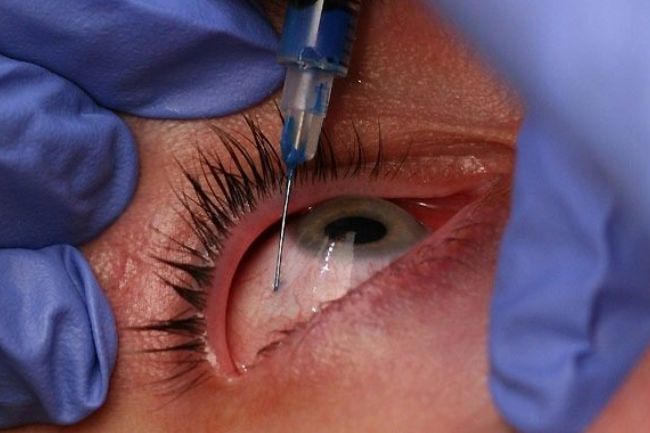 Tratamiento con Antiangiog&eacute;nicos