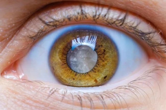 Cirug&iacute;a de cataratas