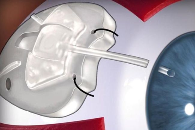 Cirug&iacute;a del Glaucoma