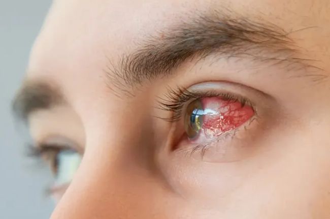 Infecciones e inflamaciones de los ojos