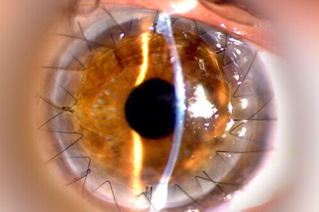 Transplante de C&oacute;rnea